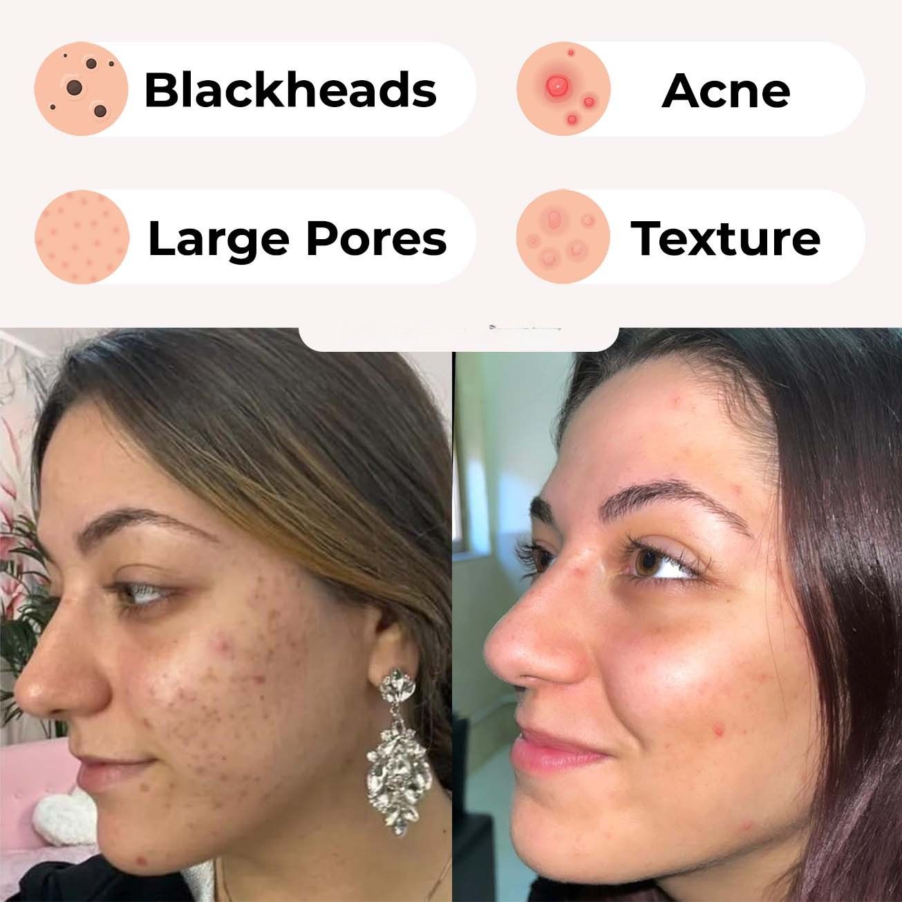 KAAZ ™ Blackhead Remover
