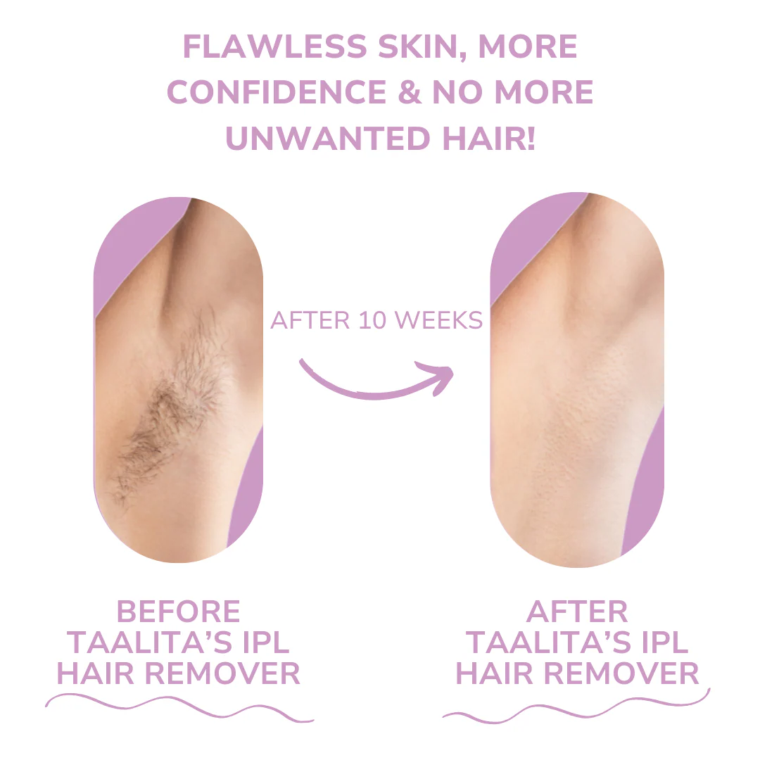 KAAZ ™ IPL Hair Remover | Hair-Free Skin in Just Weeks